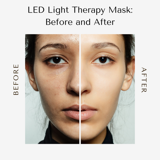 LED Light Therapy Mask: Before and After